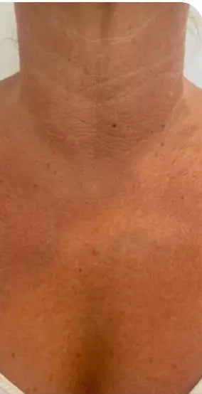 Décolleté après