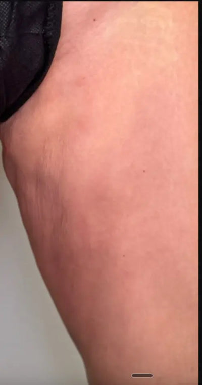 Peau après